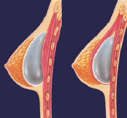 Fig. B: Hier ziet u op dwarsdoorsnede weergegeven als een borstimplantaat voor (links) of achter (rechts) de grote borstspier wordt geplaatst.